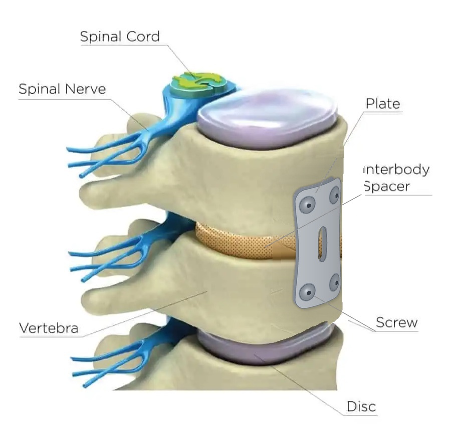 The ACDF construct: an interbody spacer between two vertebrae, with a low-profile titanium plate and four screws