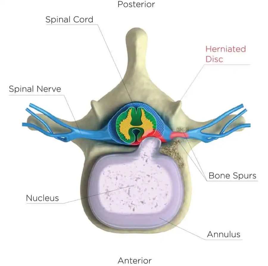 Cross-section of a cervical vertebra showing a herniated disc and bone spurs pressing into the spinal canal