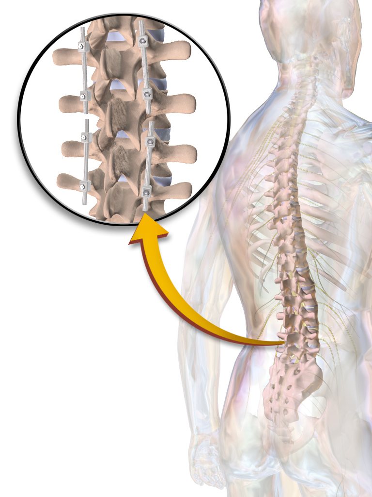 Posterior lumbar instrumentation: screws and rods attached to the back of the lumbar vertebrae