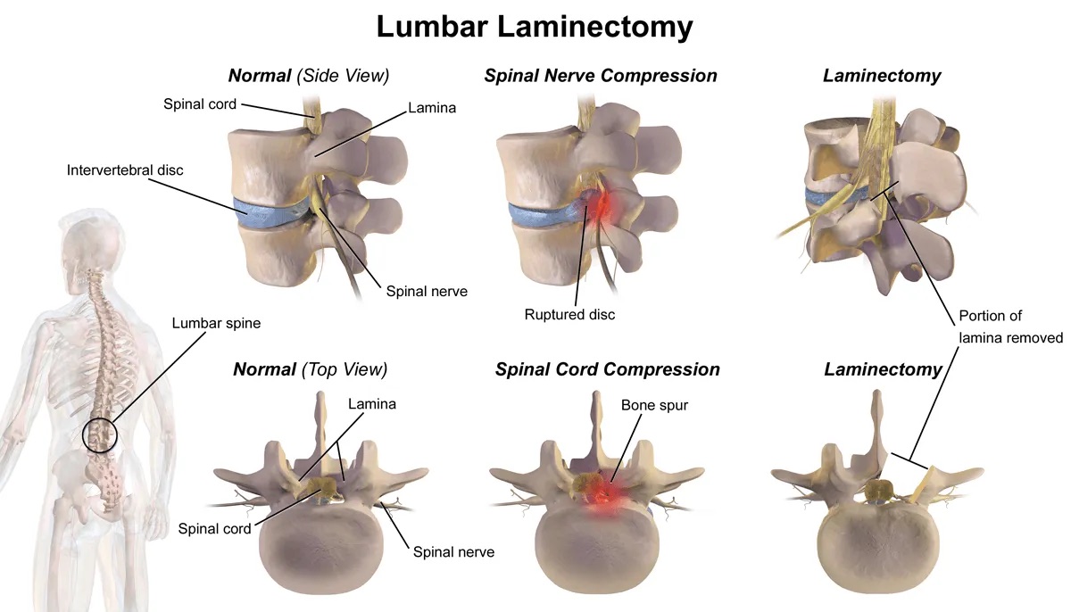 Lumbar laminectomy in side and top views: normal anatomy, nerve compression from a ruptured disc or bone spur, and the decompressed canal after part of the lamina is removed