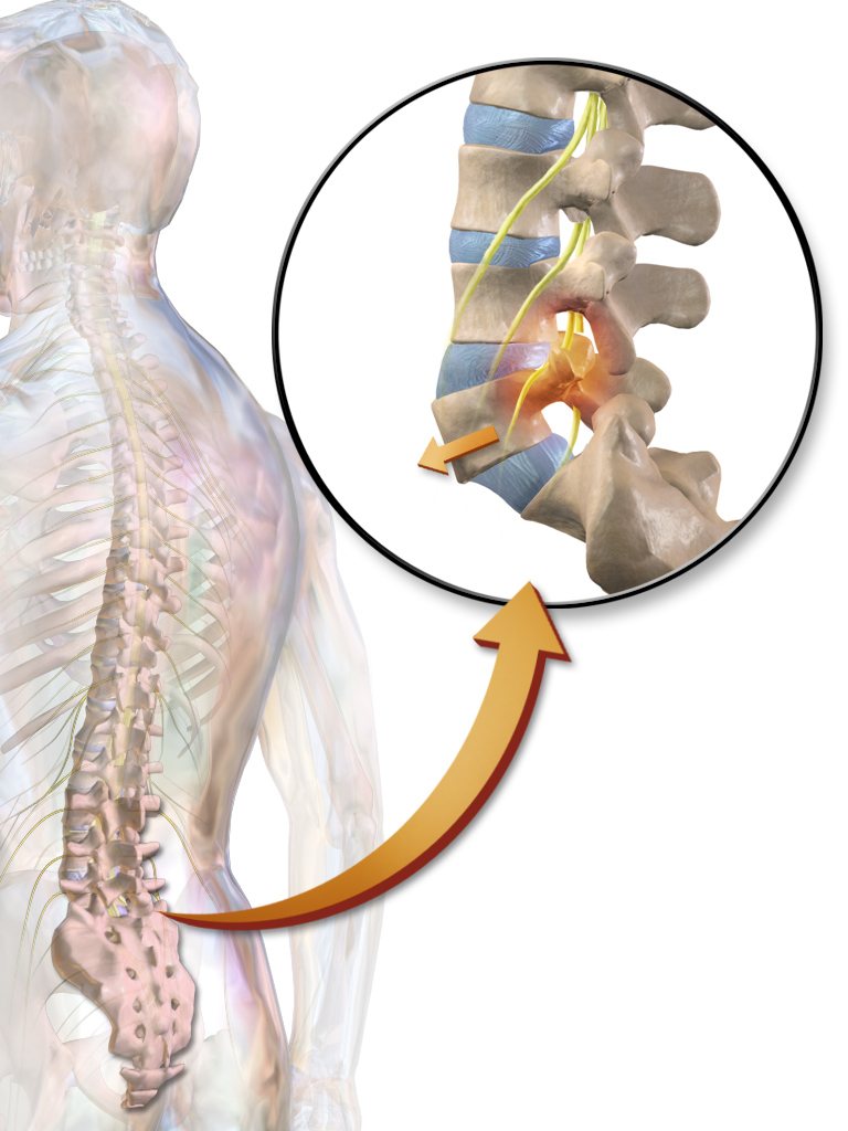 Spondylolisthesis: a lower lumbar vertebra slipping forward over the one below, pinching the nearby nerves